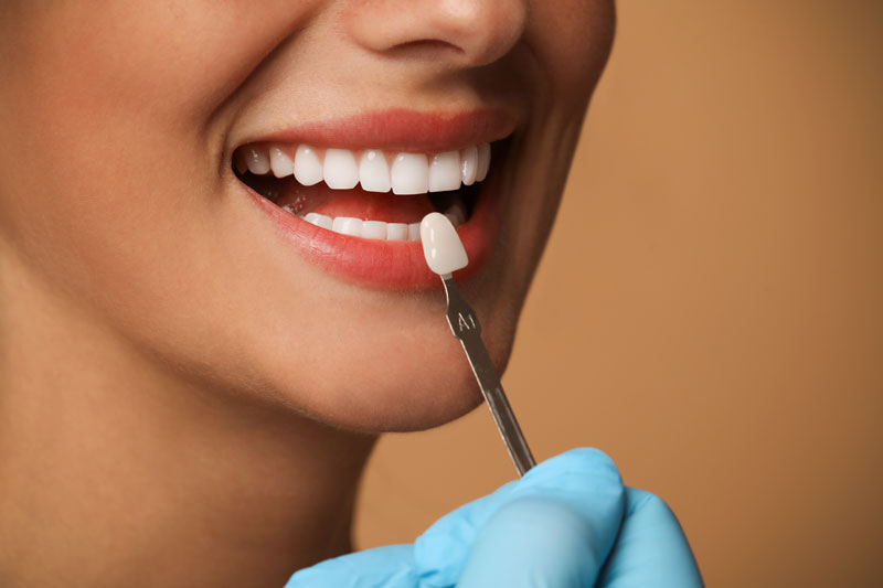 Discover the Different Types of Veneers: A Deep Dive into Porcelain Veneers