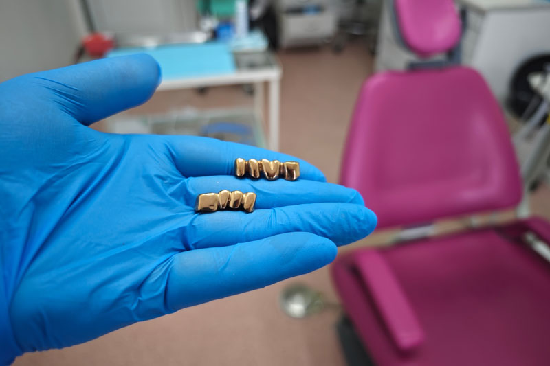 Exploring the Value of Gold Dental Crowns: What Is a Gold Crown Worth in Today’s Market?