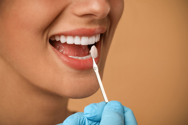 dental veneers being color matched on a womans teeth