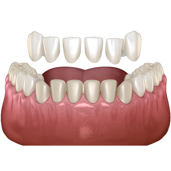 3D illustration of porcelain veneers being applied to upper front teeth, showing the cosmetic enhancement process for improving tooth appearance.